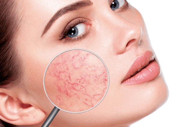 Portada qué es la rosacea
